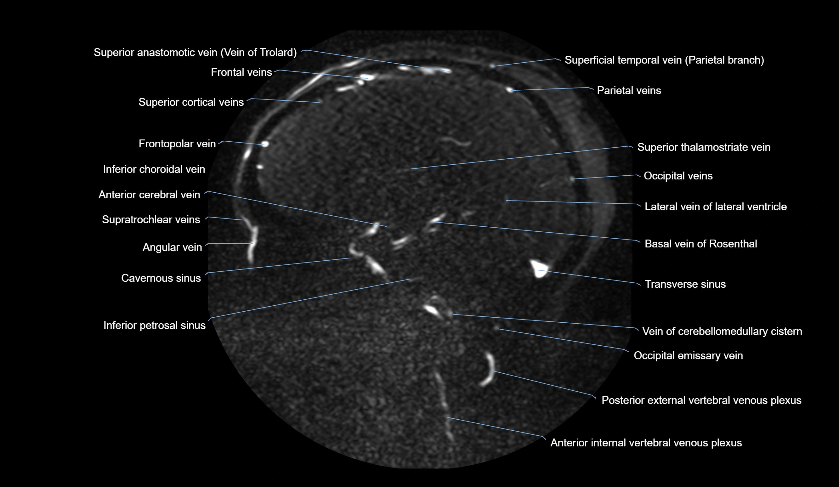 MRV brain sagittal anatomy 3T MRI images -img-01015-00037.webp